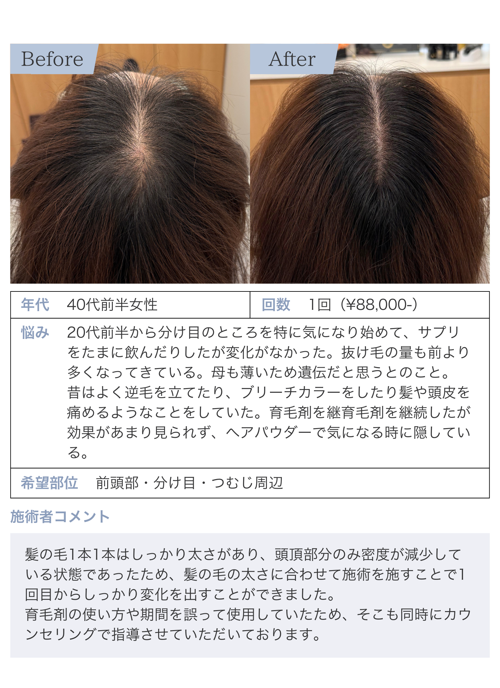 前頭部や分け目、つむじ周辺のの頭皮アートメイクを受けたお客様