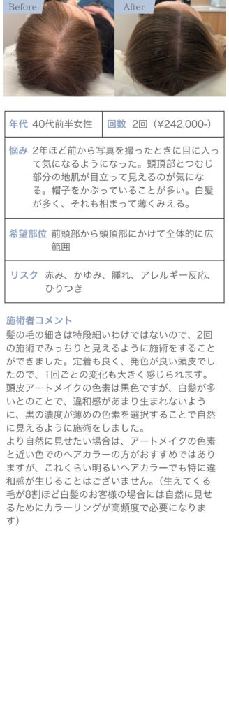 頭皮とつむじの薄毛に悩んでいた40代女性の症例