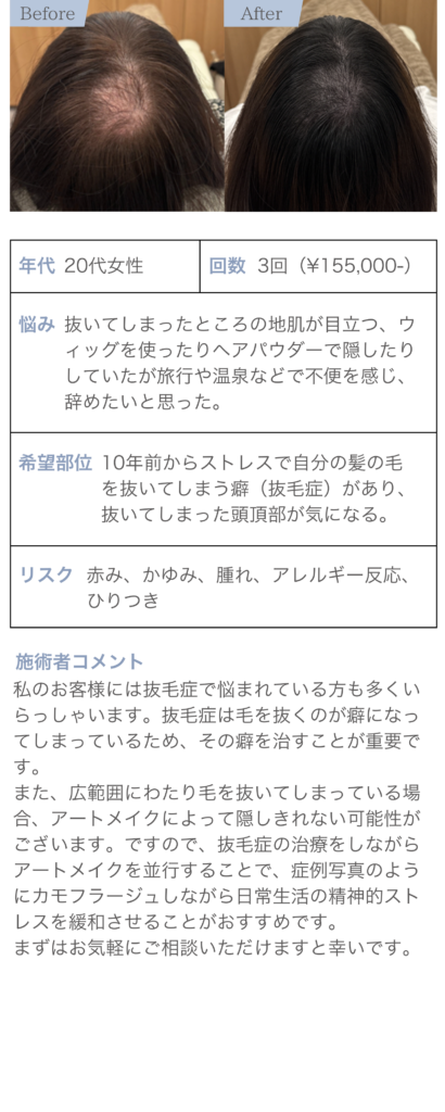 抜毛症による頭頂部の薄毛に悩む20代女性の症例